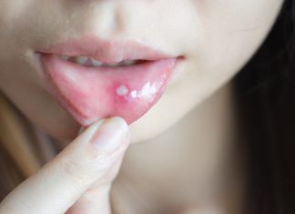 Afte bucale tratament rapid