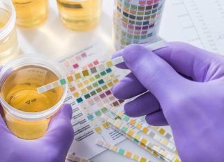 Celule epiteliale in urina