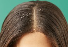 Coji pe scalp: cauze si tratamente naturiste