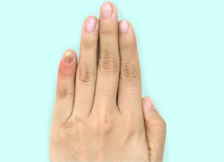 Mucegai pe unghie tratament