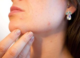 Varicela – Simptome, diagnostic si tratament